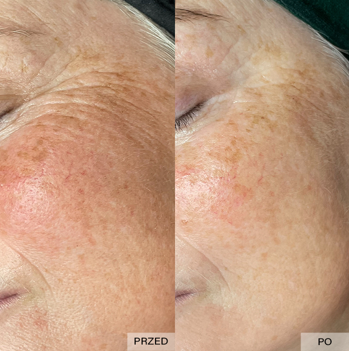 fototerapia ipl efekty